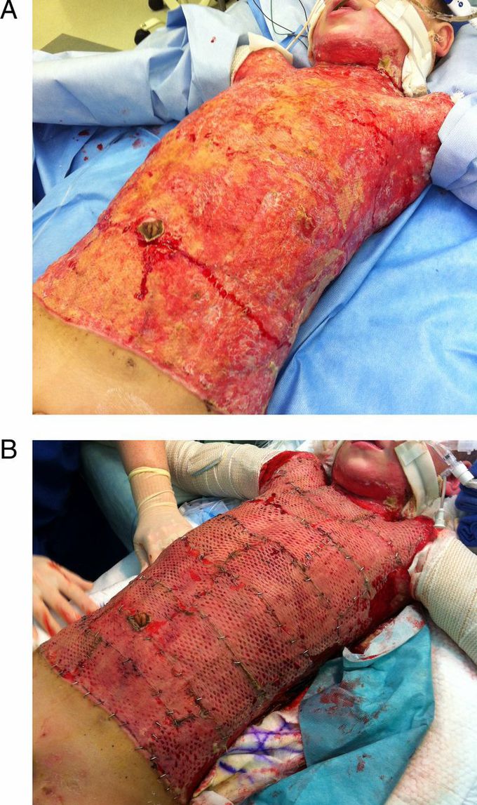 Burn injury treat