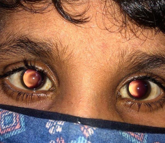 Bilateral keratoconus