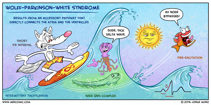 Wolf parkinson white syndrome