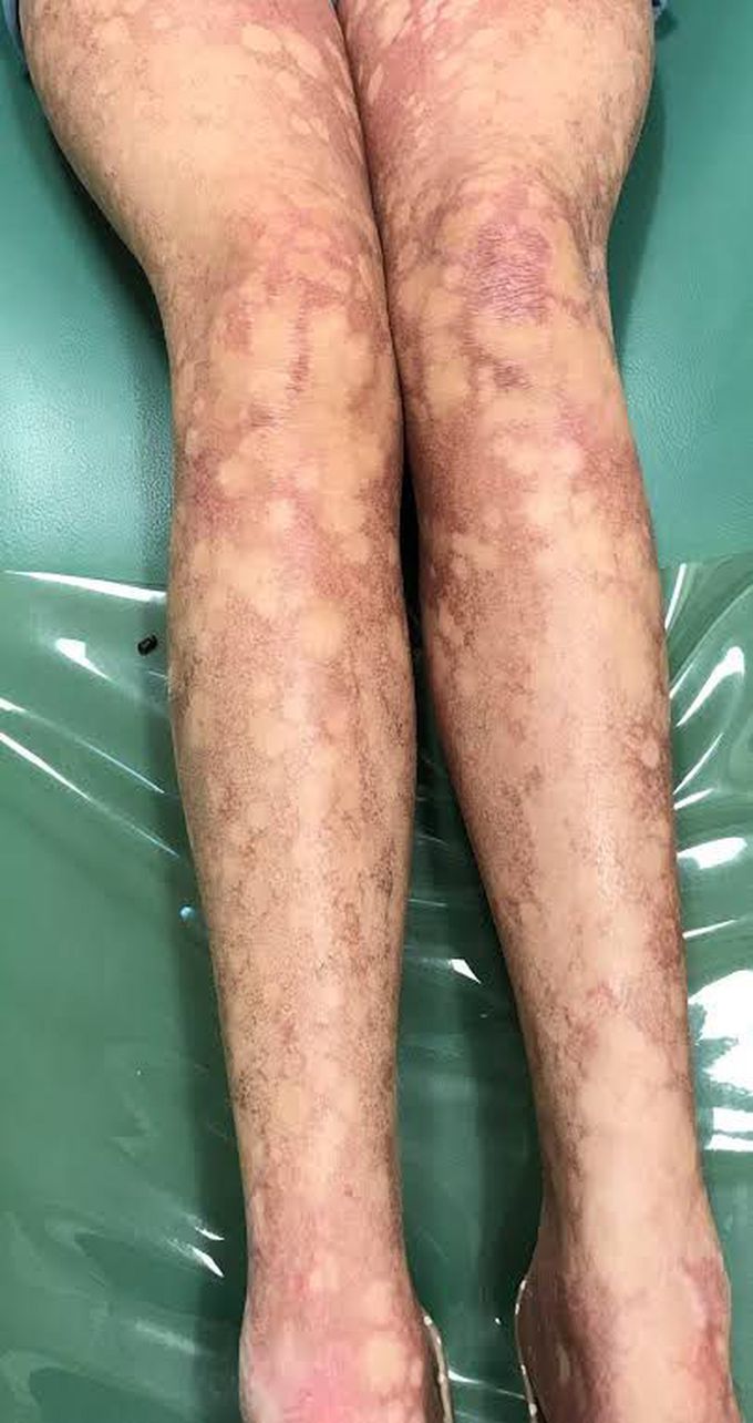 Dyskeratosis Congenita