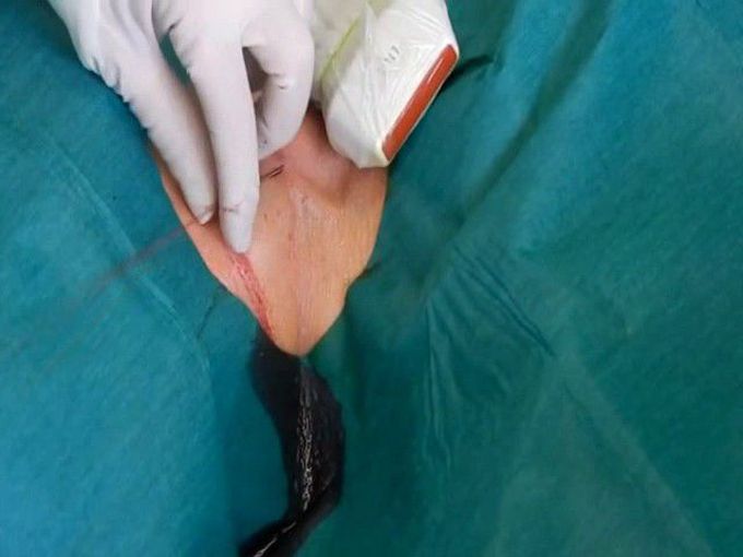 MMCTS - Endomyocardial biopsy under echocardiographic monitoring