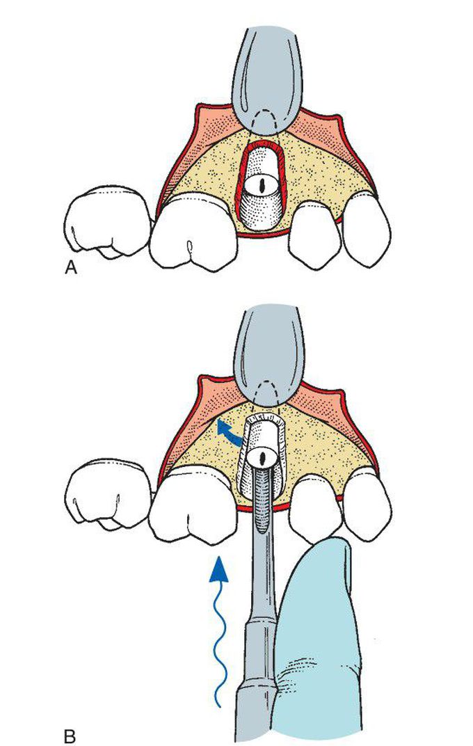 Removal of root tip