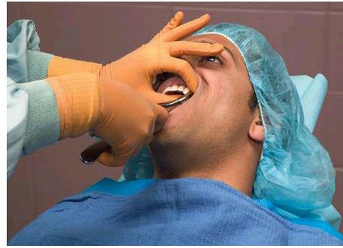 Extraction of maxillary left posterior teeth.