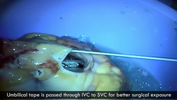 Heart Transplantation for a Failed Fontan