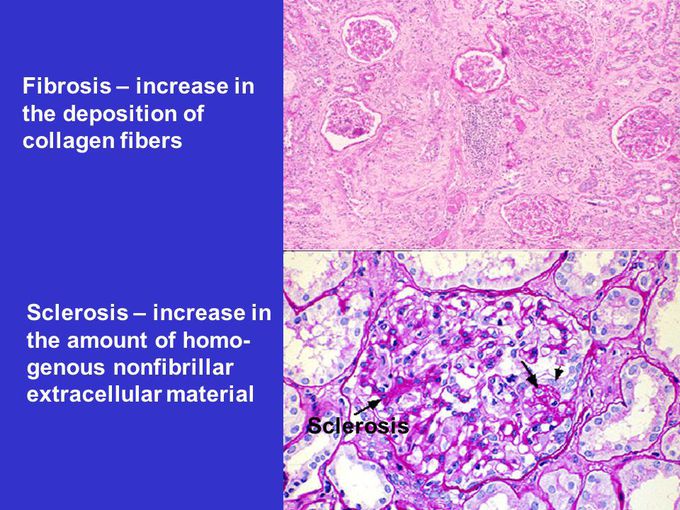 Fibrosis vs sclerosis