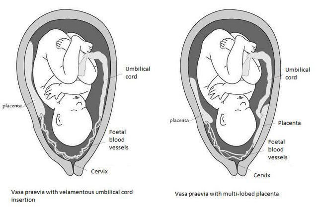 Symptoms Of Vasa Previa - Medizzy