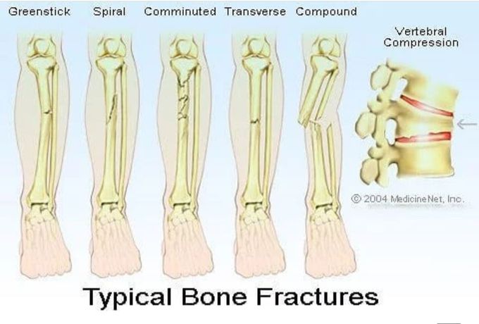 Typical bone fracture