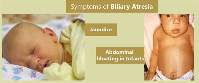 Symptoms of Biliary atresia - MEDizzy