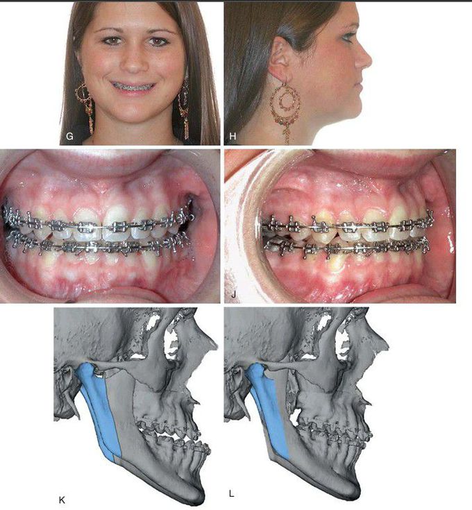 Mandibular excess