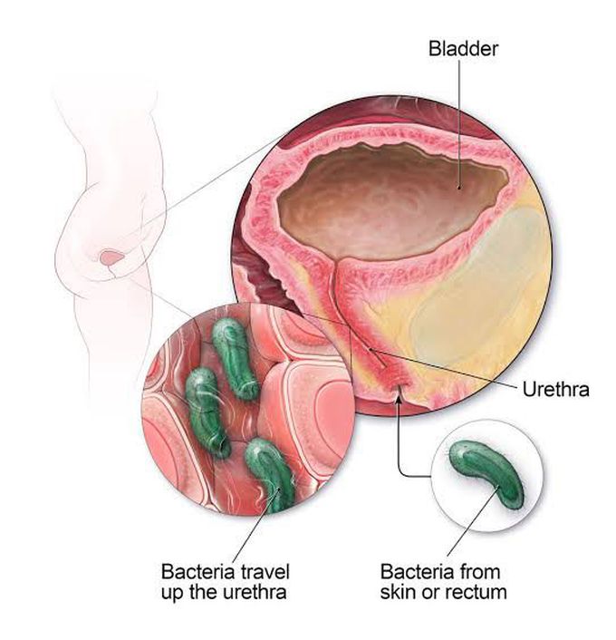 Urinary tract infection