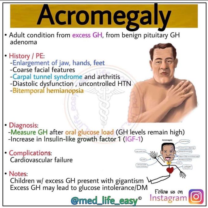 Acromegaly