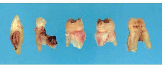 Fracture of alveolar process