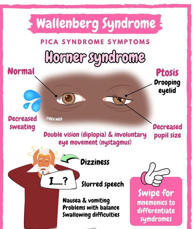 Wallenberg Syndrome II