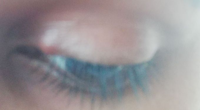 Stye in eye