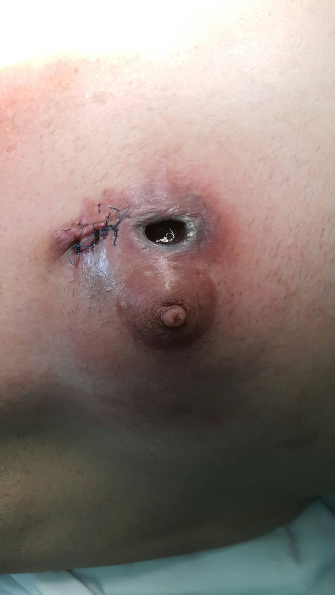 Breast melanoma