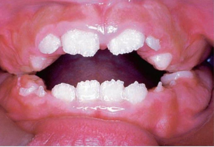 Amelogenesis imperfecta