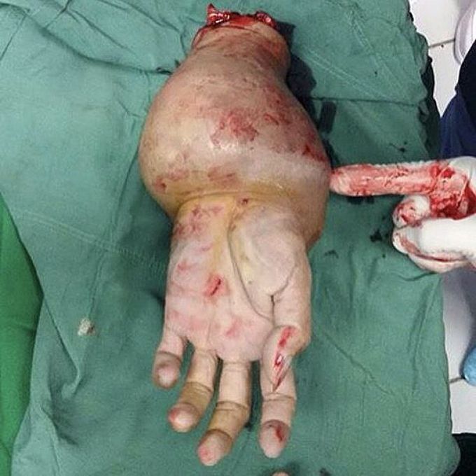 Giant-cell tumor of the distal radius