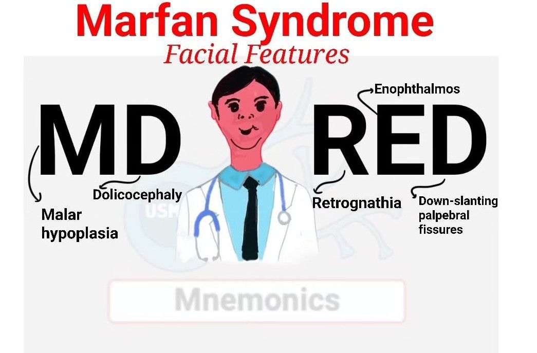 enoftalmos marfan