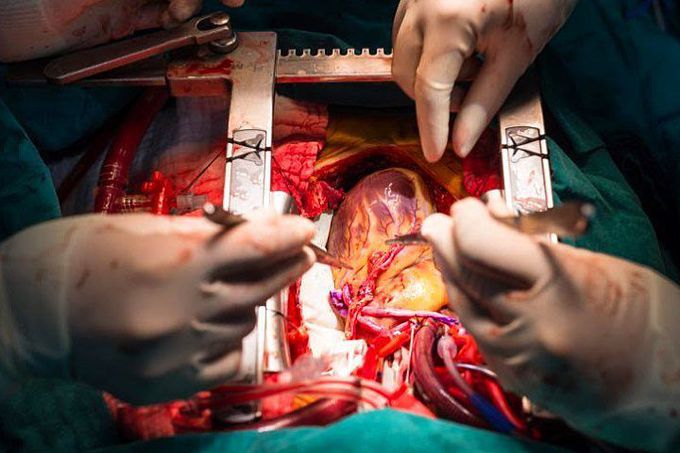 Coronary artery bypass grafting