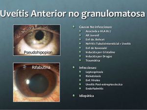 Uevitis Anterior - Medizzy