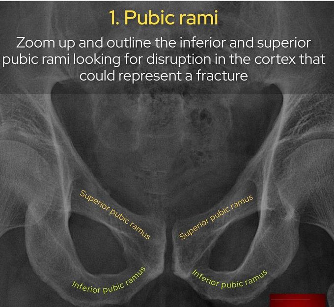 Pubic Rami