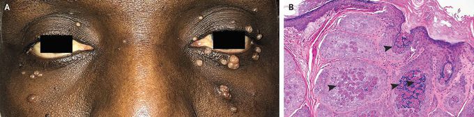 Molluscum Contagiosum