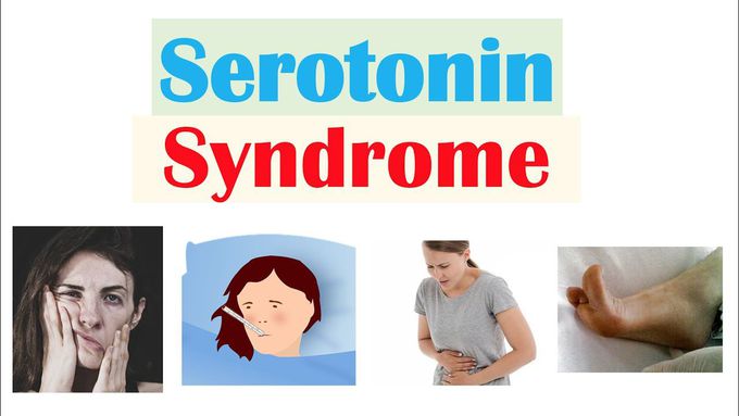 Serotonin Syndrome | Causes (Medications), Pathophysiology, Signs & Symptoms, Diagnosis, Treatment