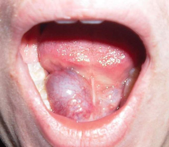 Ranula Sublingual