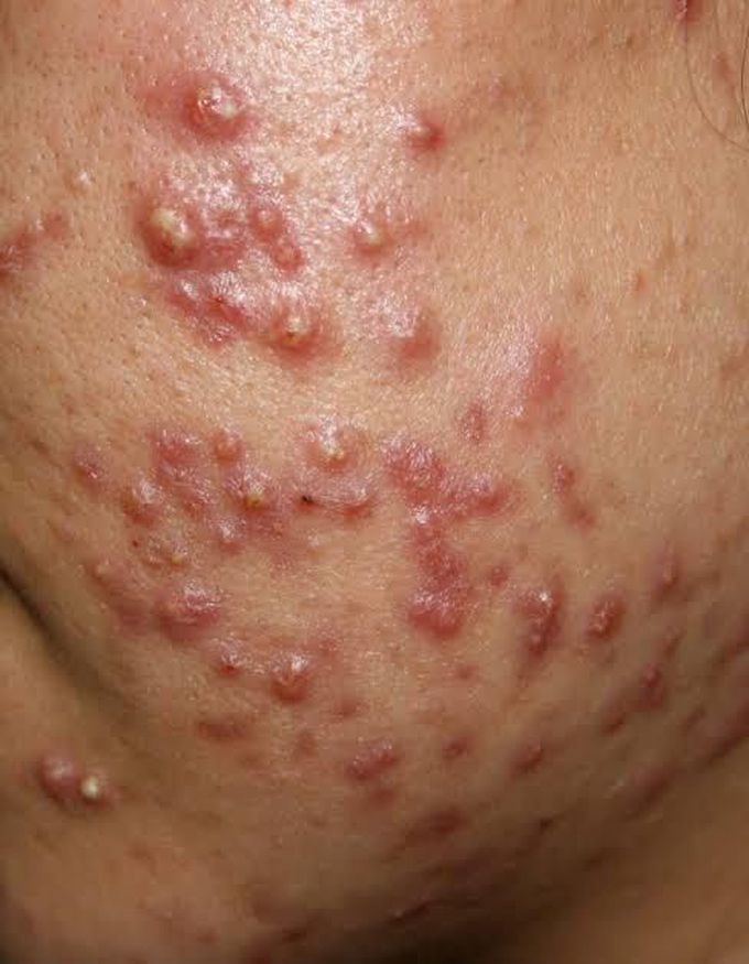 Acne vulgaris