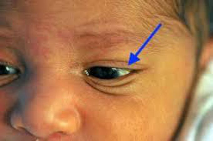 Causes of congenital hyperbilirubinemia