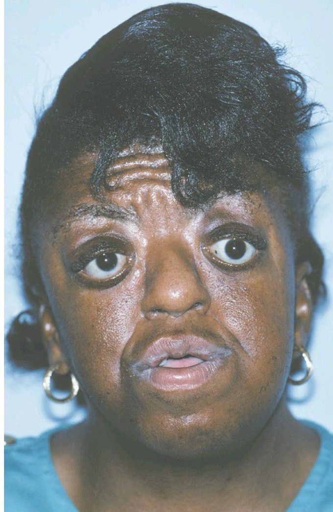 Apert syndrome