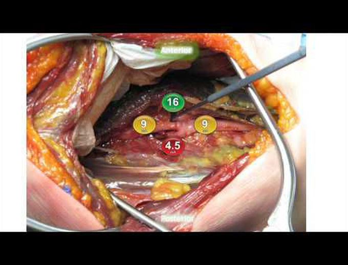 MIS lateral ACR for spinal deformity correction: technique and complication avoidance