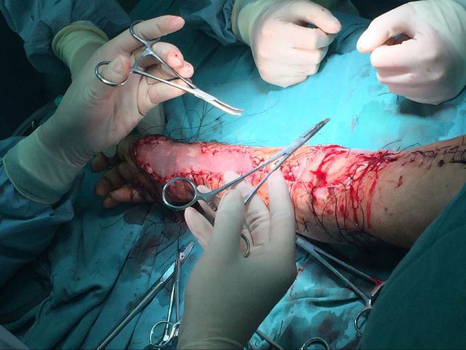 Hand surgery