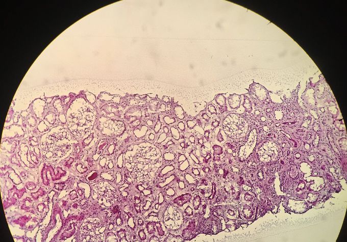 kidney biopsy