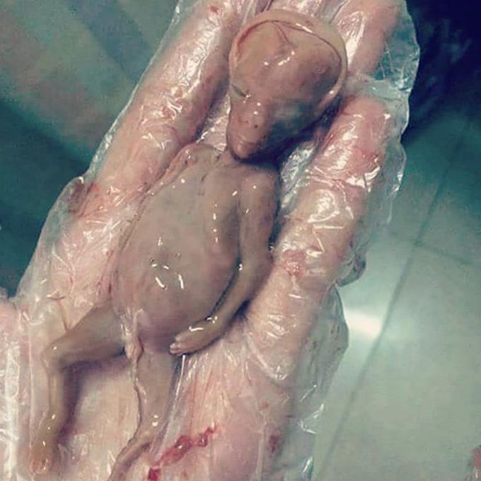 Fetus