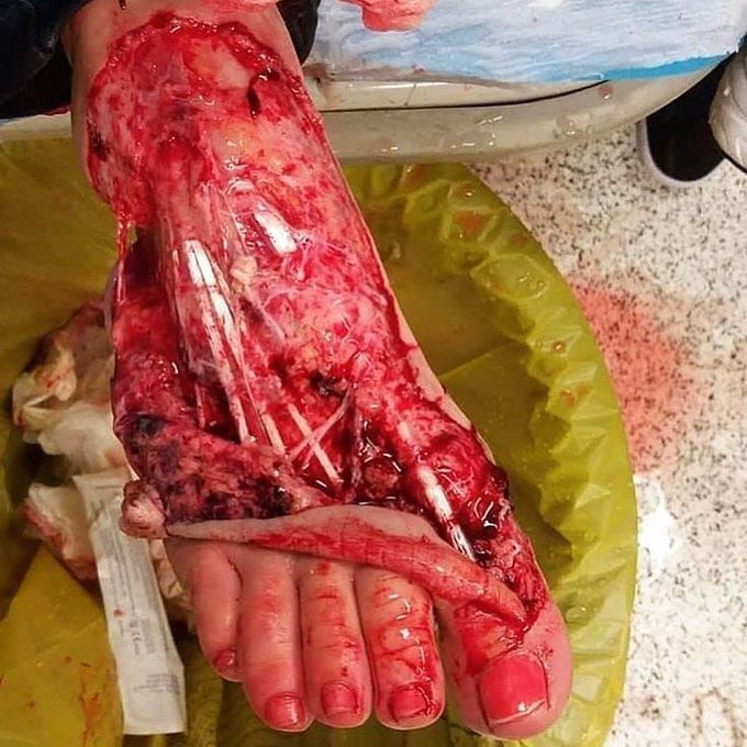 ⚠️ Motorcycle injury! 