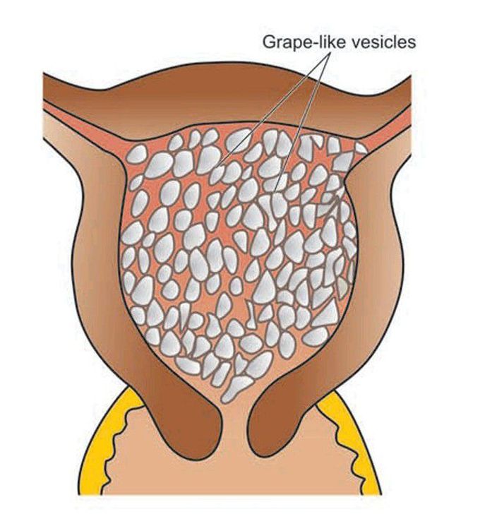 Hydatidiform mole