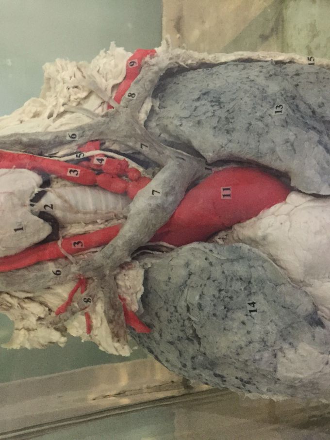 Do you know what is wrong with this heart❓🤔