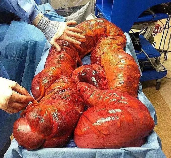 Toxic Megacolon