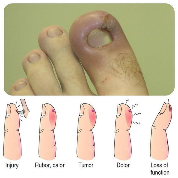 Signs of inflammation