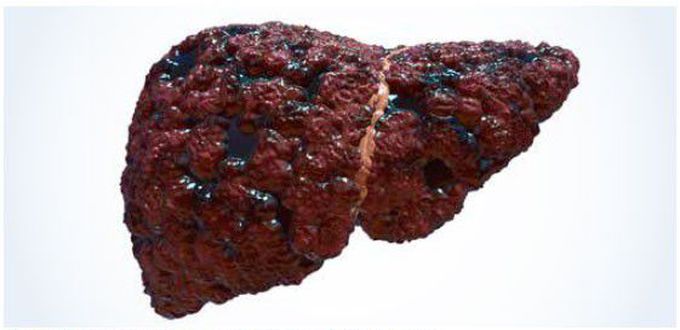 Liver cirrhosis