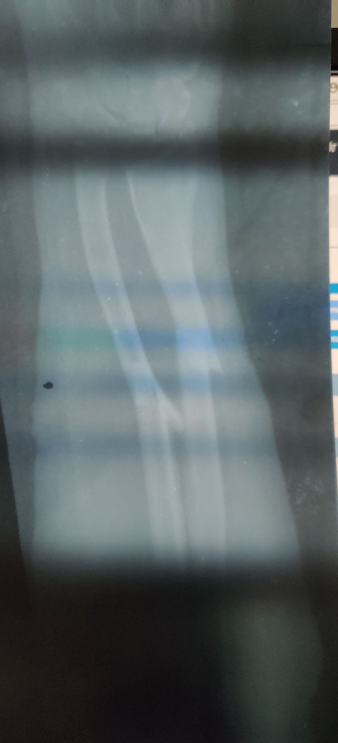 Fracture radius & ulna - MEDizzy