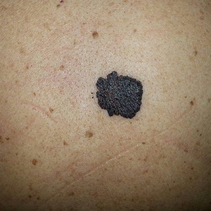 Small melanoma