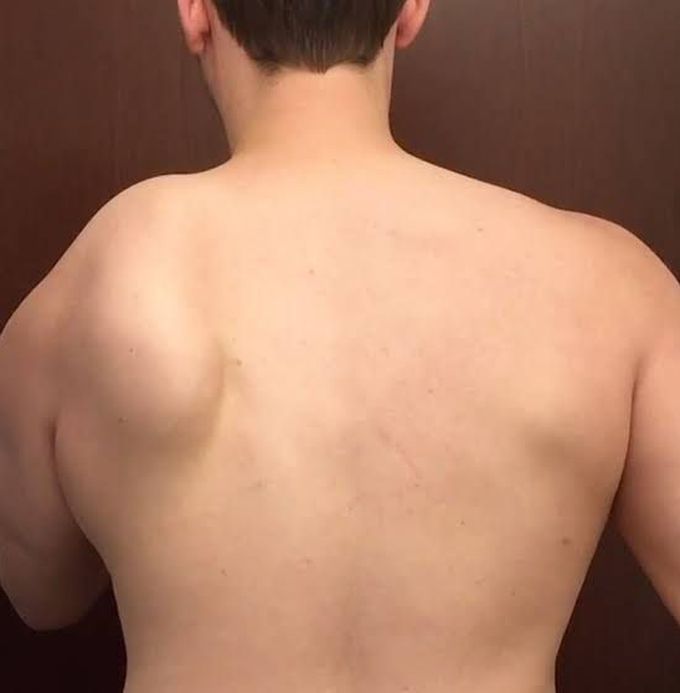 Winged scapula