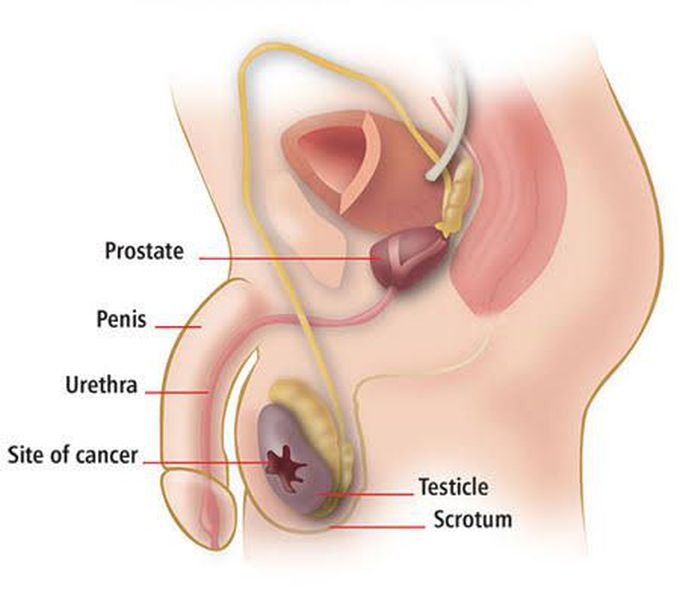 Symptoms of testicular cancer