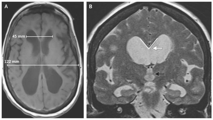 Ventriculoperitoneal-Shunt Placement for Normal-Pressure Hydrocephalus