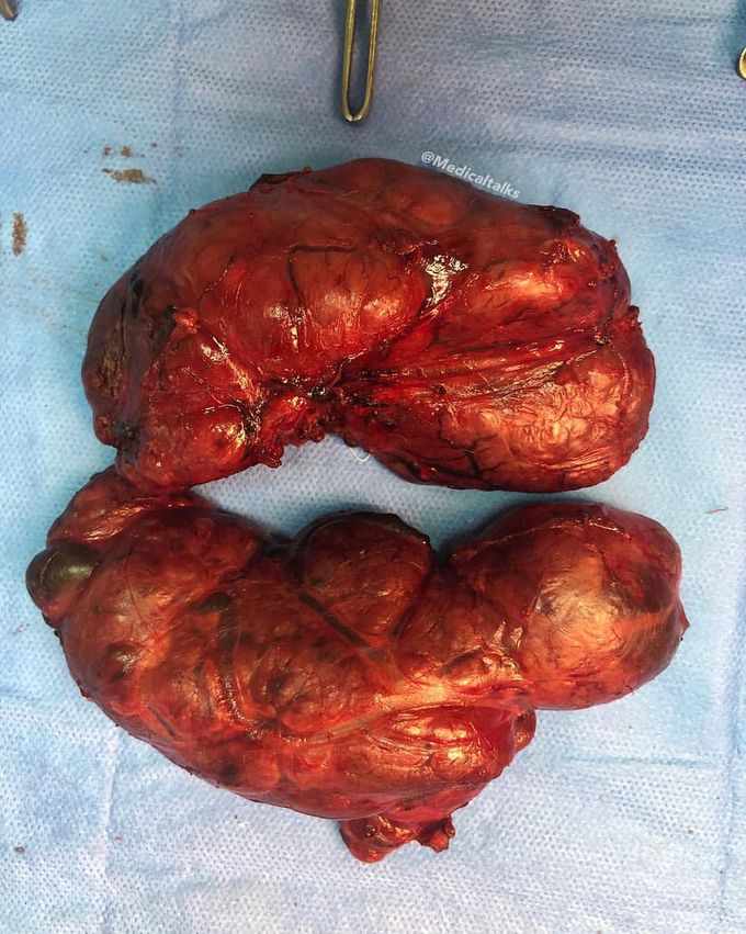 Kidneys? No, just a big ol’ thyroid! 