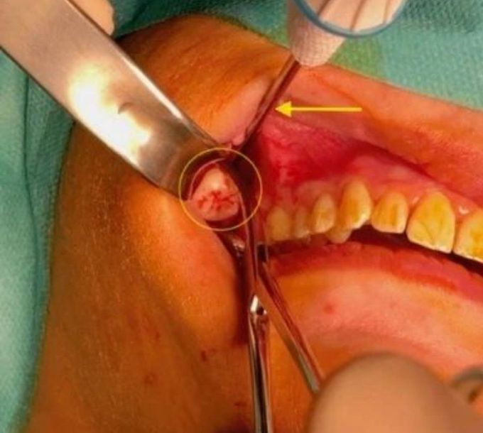 Tooth in the Infratemporal Fossa