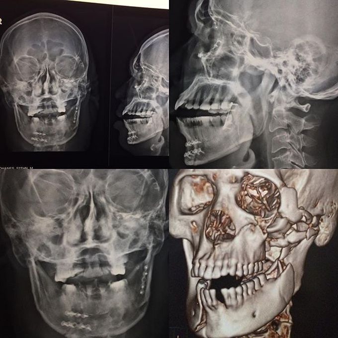 Facial bone fracture and its fixation