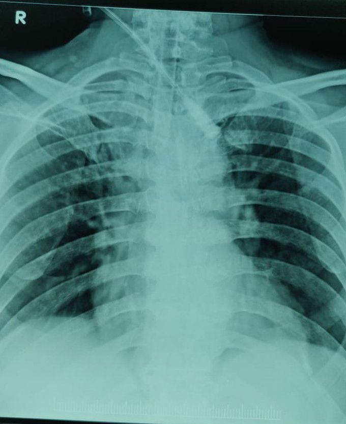 Interpretation 58 yr old male poioson consumption phenthoate along with alprax 0.5mg 10 tablets and metformin 10 tablets,pt treated and stabilised for 24hrs and then saturation falls E.M doctor advised for ventilatory support,but he explained about weekening of chest muscles